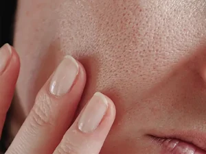 چگونه منافذ پوست را قبل از آرایش ببندیم؟